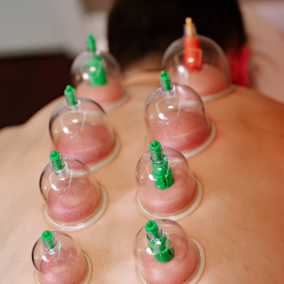Odnova Massage Therapy_London_Chinese Cupping Massage